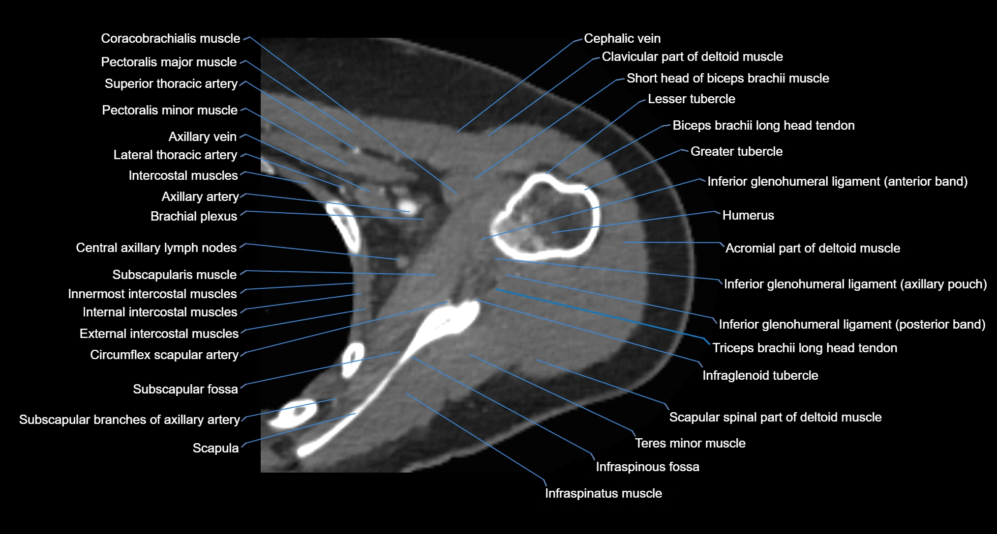 CT Shoulder axial cross sectional anatomy labelled radiology image -00040.webp